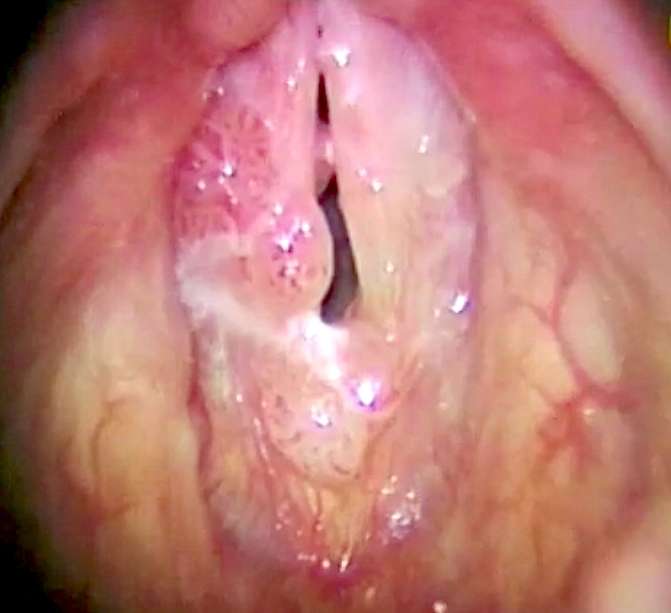 mărirea condilomului papilloma virus sintomas
