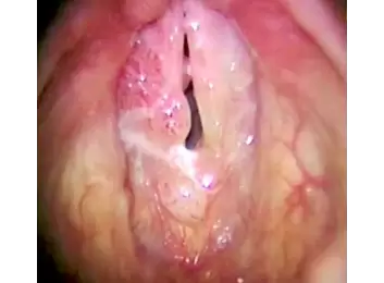 Laringeal Papillomatosis