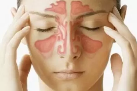 Sinüzitte İlaçlı Balon Tedavisi