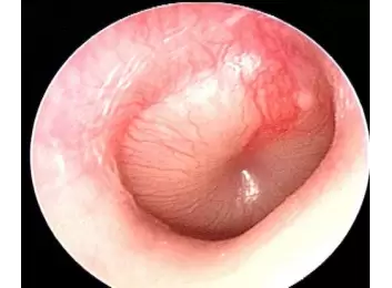 akut orta kulak iltihabı