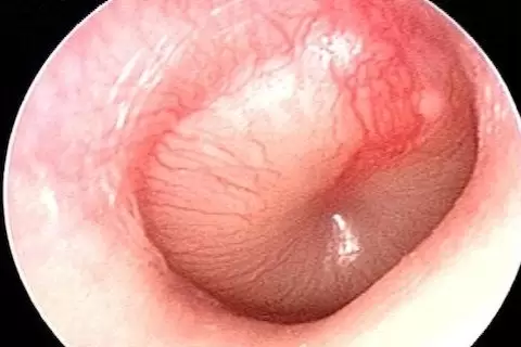 akut orta kulak iltihabı