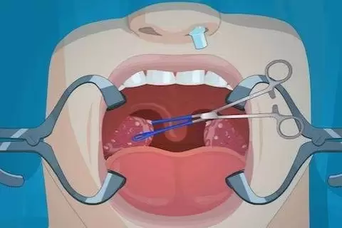Bademcik Ameliyatı (Tonsillektomi)