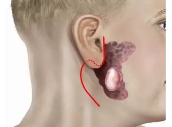 Tükürük Bezi Ameliyatı