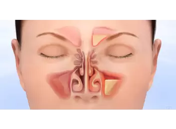 Balonla Sinüs Ameliyatı