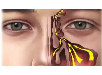 Balon ile Sinüzit Ameliyatı