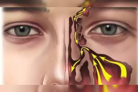 Balon ile Sinüzit Ameliyatı