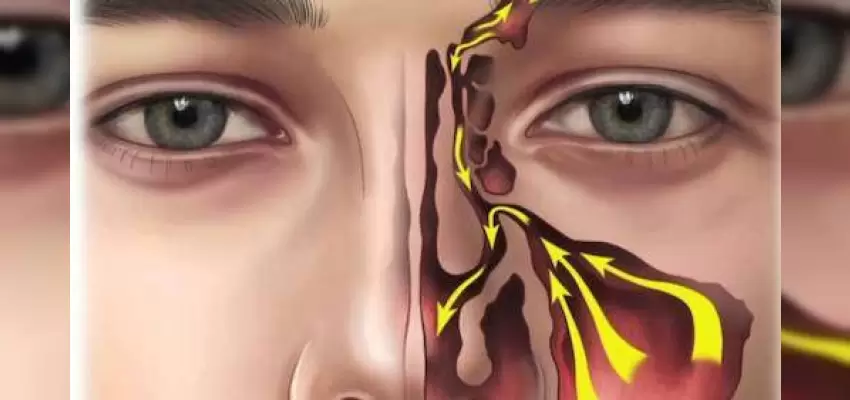 Balon ile Sinüzit Ameliyatı