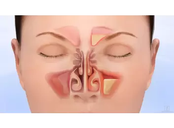 Bilgisayar Destekli (Navigasyonlu) Sinüzit Ameliyatı