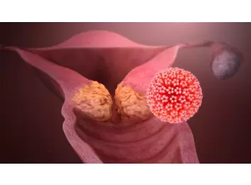 HPV (Human Papilloma Virus)