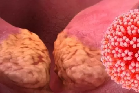 HPV (Human Papilloma Virus)