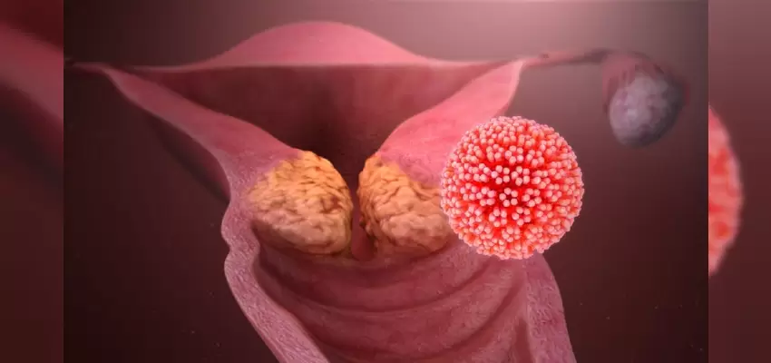 HPV (Human Papilloma Virus)