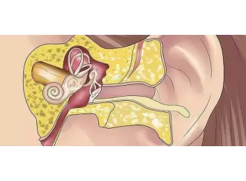 Orta Kulak İltihabı (Kronik Otisis Media)