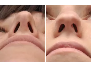 Revizyon Burun Estetiği