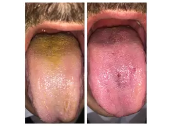 Mikrobiyotamızın Önemi